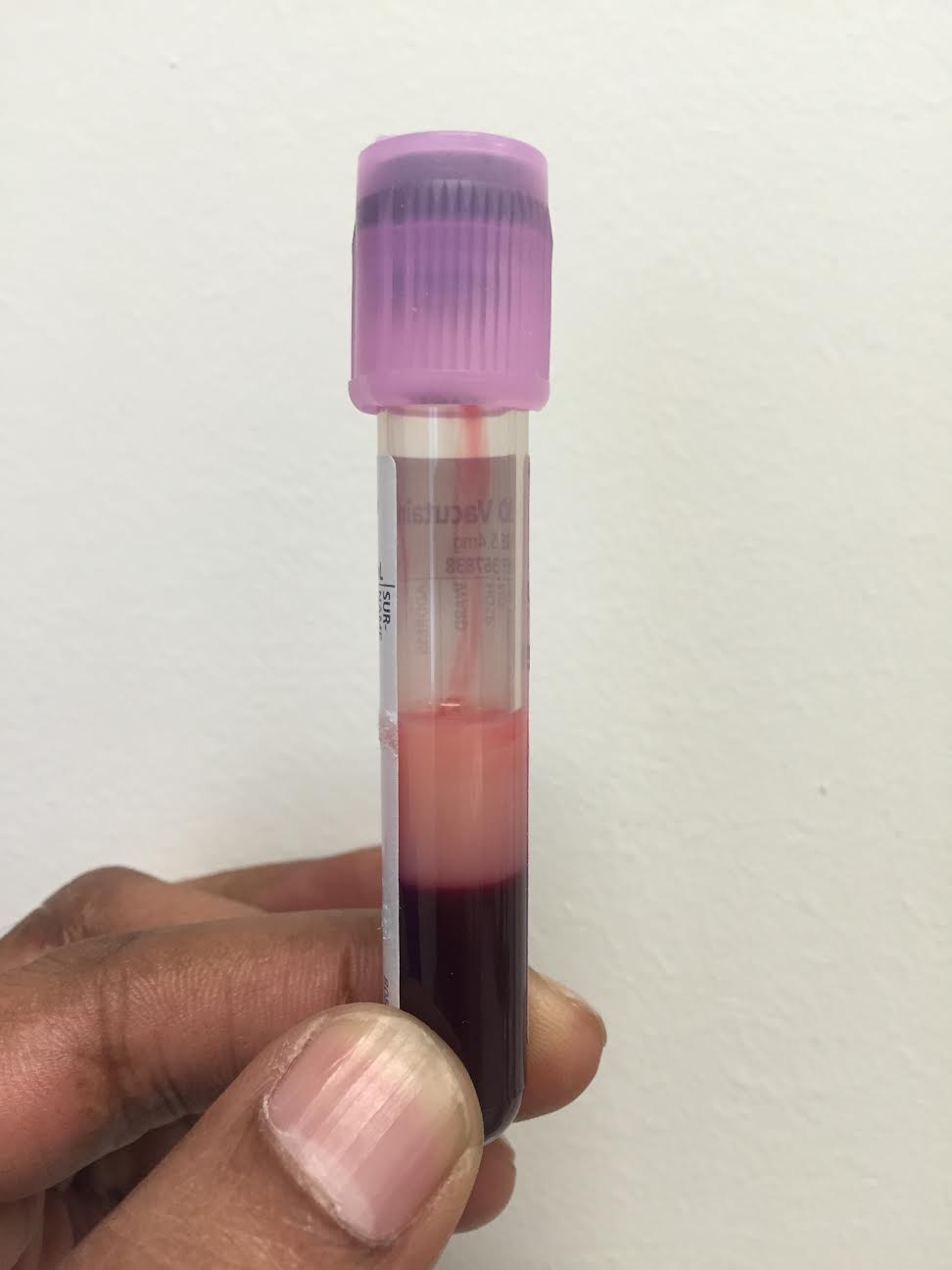 Blood with high triglycerides and supernanatant (triglyceride level was 45 g/L)