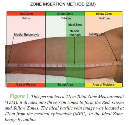 PICC zone insertion method - Dawson (2011)