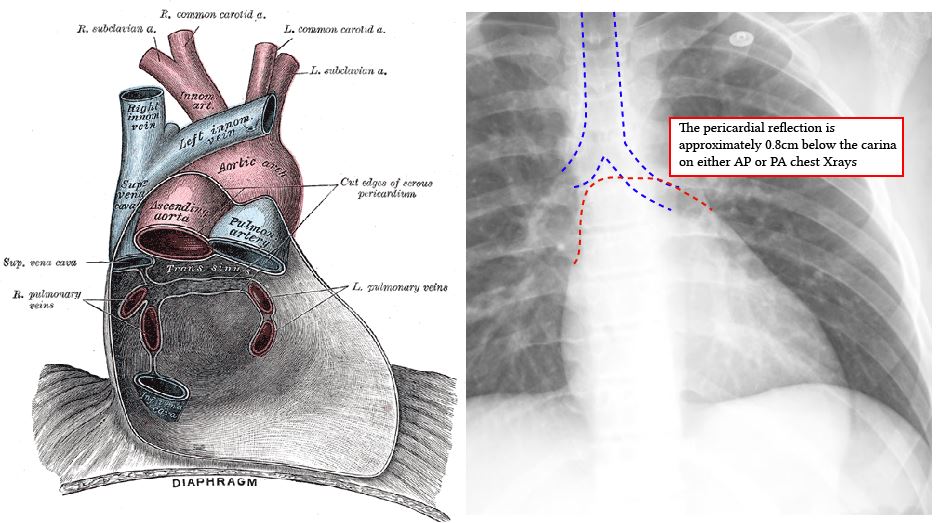 position of the pericardial reflection on chest xrays