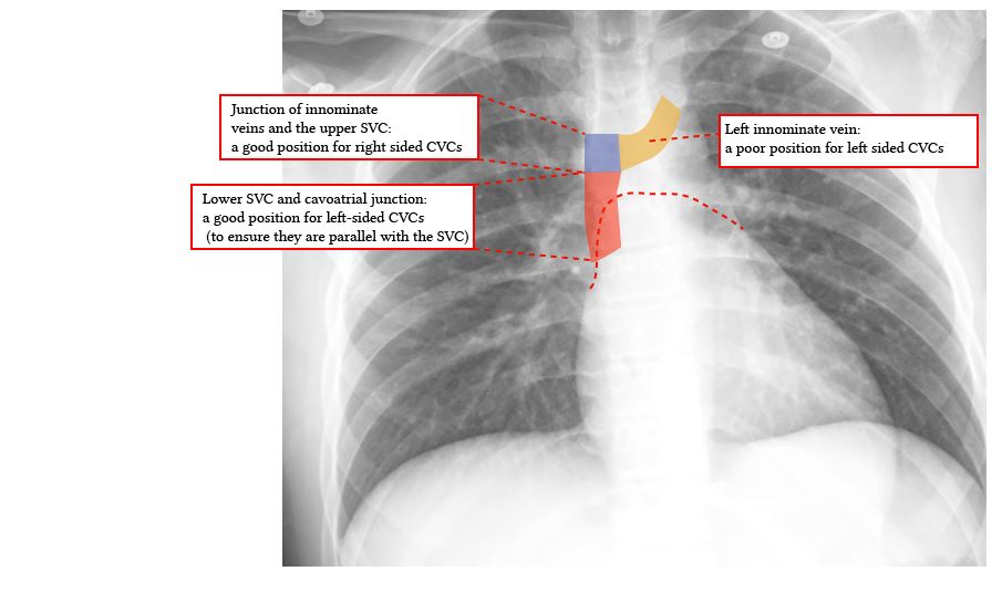radiological zones for CVC position within the SVC and innominates