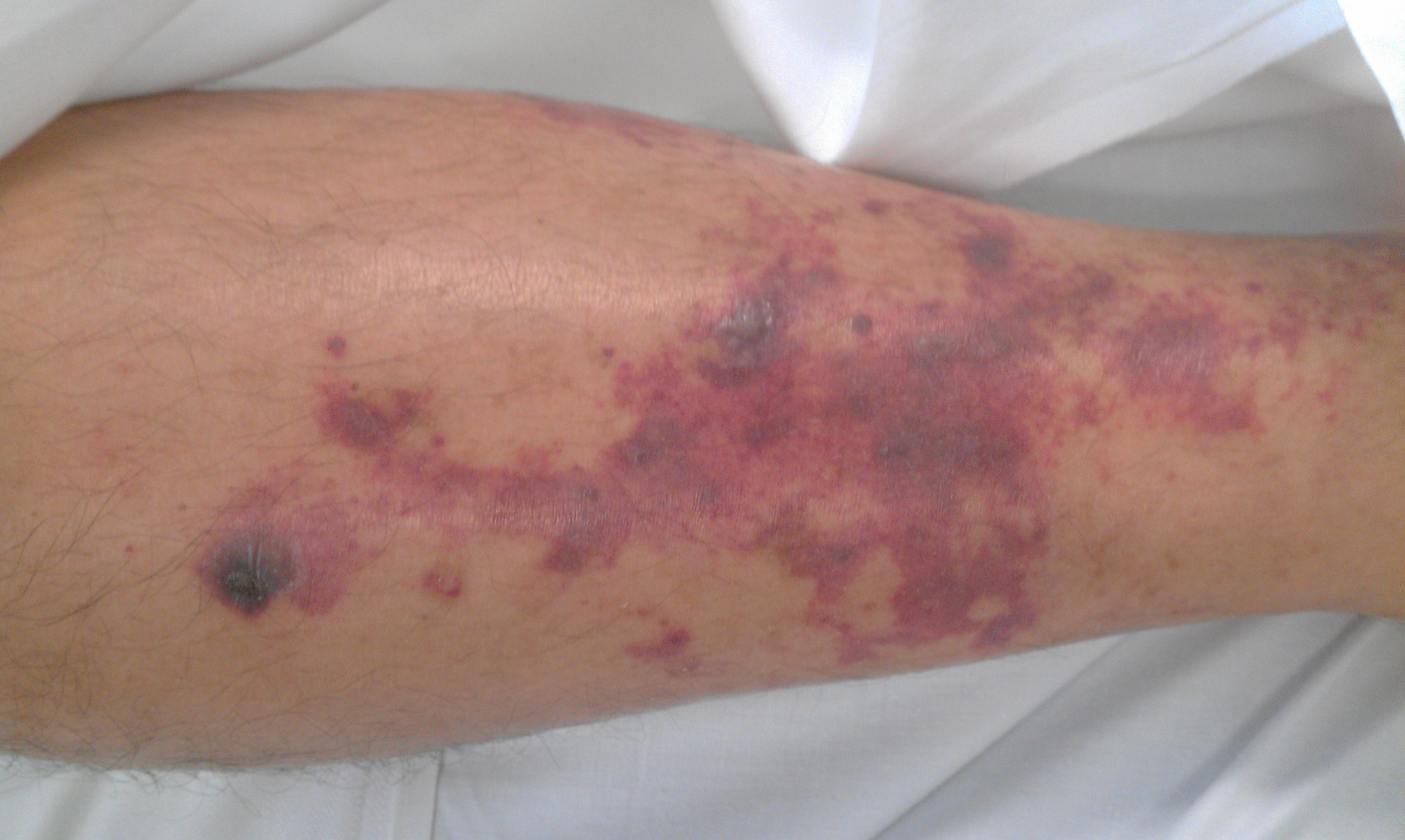 Purpura fulminans in an asplenic adult
