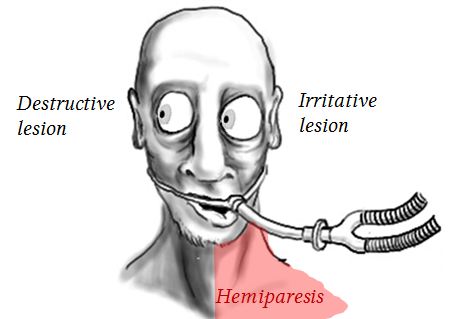 Conjugate lateral gaze deviation in the unconscious patient