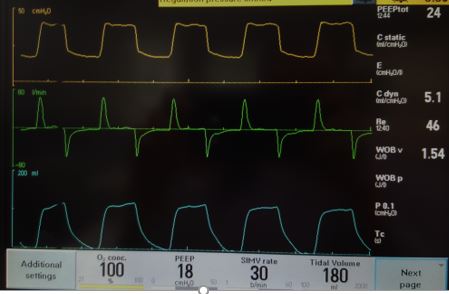 Severe ARDS ventilator screen