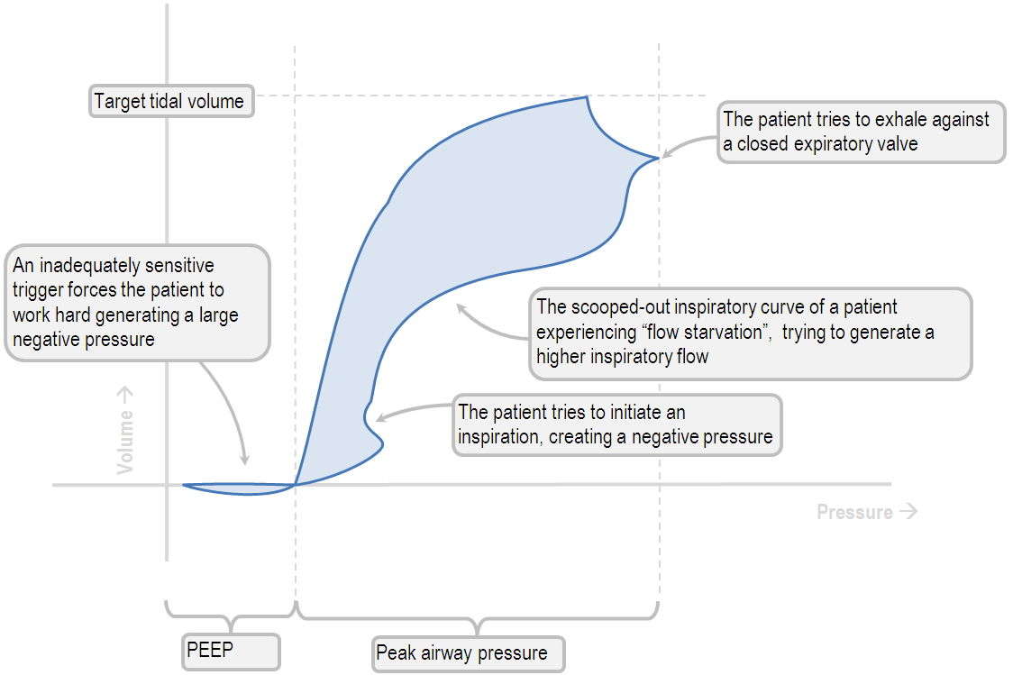 A pressure-volume loop with patient-ventilator dyssynchrony