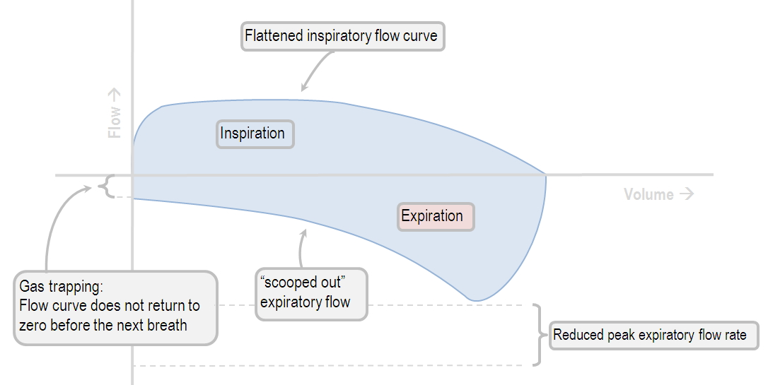 Flow-volume loop in obstructive lung disease