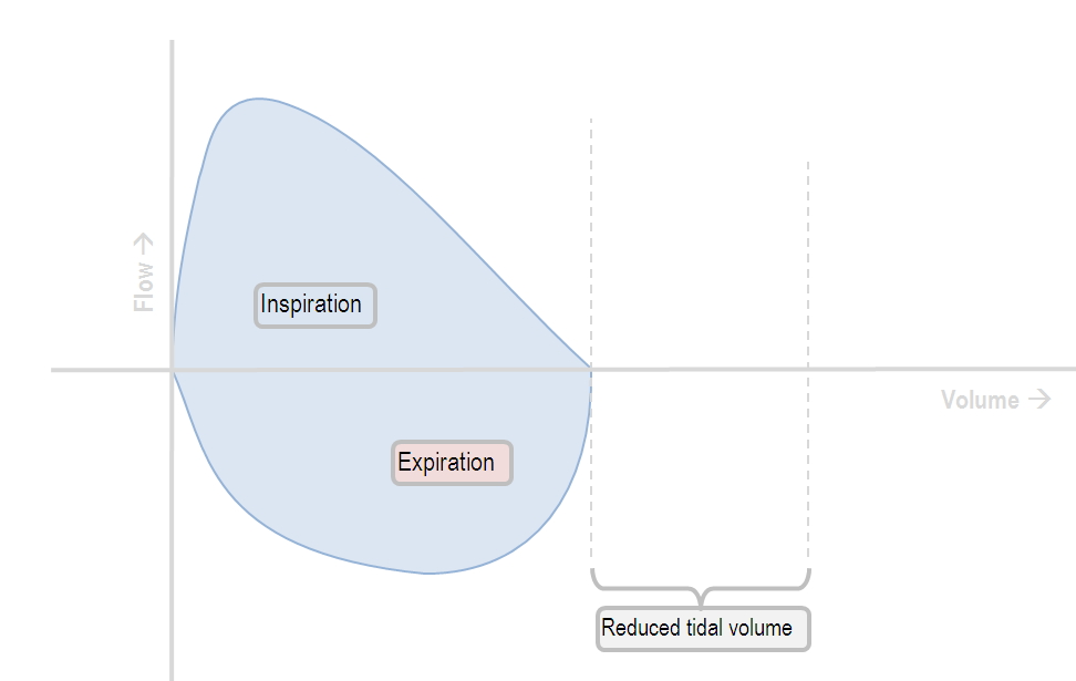 Flow-volume loop in obstructive lung disease