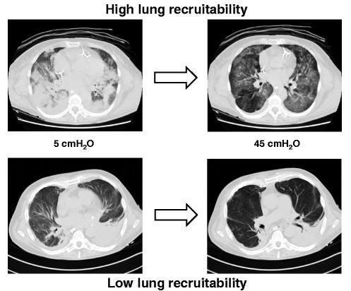 high recruitable and poorly recruitable lung CTs