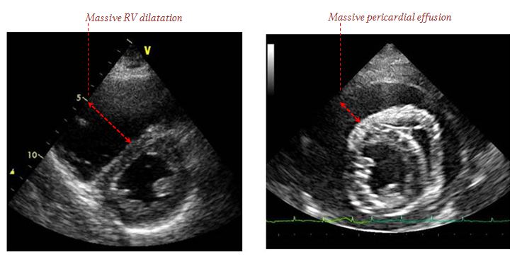 Peri-arrest transthoracic echo