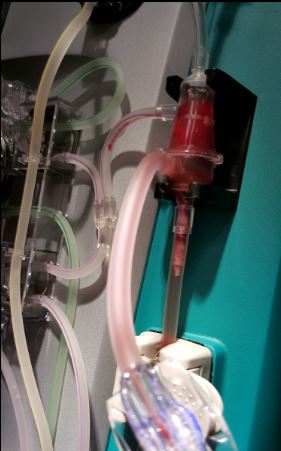 return pressure extremely positive: a lump of fibrinous clot in the bubble trap of the dialysis circuit