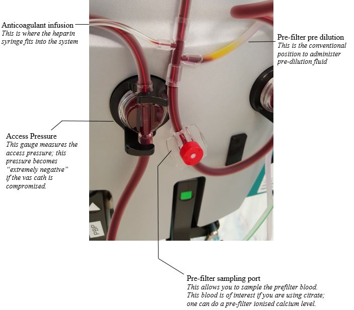 pre-filter CVVHDF circuit up close